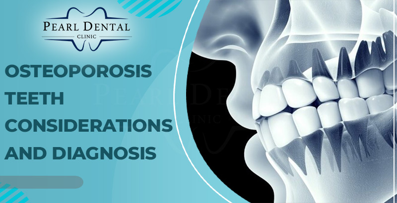 Osteoporosis Teeth Considerations & Diagnosis