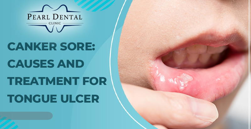 Canker Sore Causes and Treatment